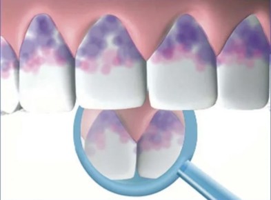 Зубной налёт под контролем: как индикаторы помогают улучшить гигиену полости рта